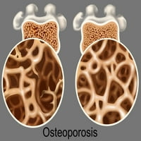 Osteoporotic & normál csont Poszter Nyomtatás Gwen Shockey tudományos forrás